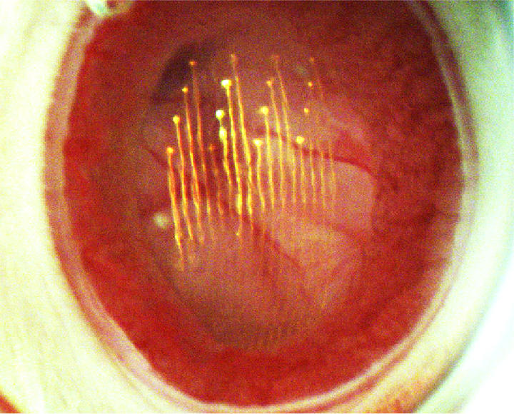Dr. Lieber's tissue-like mesh acts like an artificial receptor layer